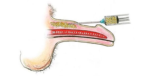 Injections of hyaluronic acid into the barrel of a member to increase